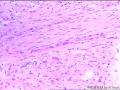 右侧腰大肌肿块穿刺活检组织，怎么考虑？图22