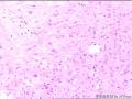 右侧腰大肌肿块穿刺活检组织，怎么考虑？图19