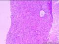 右侧腰大肌肿块穿刺活检组织，怎么考虑？图10