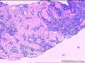右颈部淋巴结穿刺组织，怎么考虑？图6