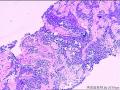 右颈部淋巴结穿刺组织，怎么考虑？图3