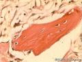 纤维结构不良还是动脉瘤样骨囊肿？图18
