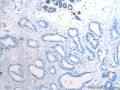 乳腺穿刺：考虑乳腺浸润性导管癌，1级？图15
