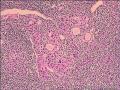 慢性淋巴细胞甲状腺炎，这些上皮没问题吧图2