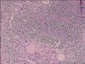 慢性淋巴细胞甲状腺炎，这些上皮没问题吧图7