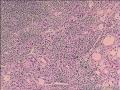 慢性淋巴细胞甲状腺炎，这些上皮没问题吧图11