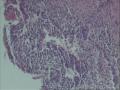 上皮内瘤变还是早起浸润癌？图8