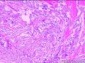 29岁女性，右眶沟肿瘤，请会诊！图28