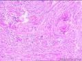 29岁女性，右眶沟肿瘤，请会诊！图13