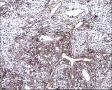 右小腿肿物图17