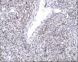 右小腿肿物图18