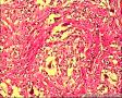 丛状纤维组织细胞瘤图2