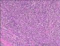 附睾是淋巴瘤还是炎症，精原细胞瘤图16