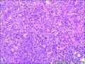 左颈部淋巴结肿大图5