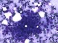 典型图片之（15）：FNA（乳腺癌）2图1
