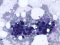 典型图片之（16）：FNA（乳腺癌）3图3