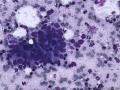 典型图片之（15）：FNA（乳腺癌）2图8
