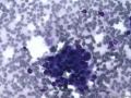 典型图片之（16）：FNA（乳腺癌）3图5