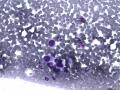 典型图片之（14）：FNA(乳腺癌)1图6