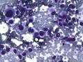 典型图片之（14）：FNA(乳腺癌)1图4
