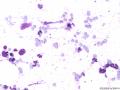 典型图片之（15）：FNA（乳腺癌）2图3