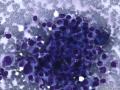 典型图片之（14）：FNA(乳腺癌)1图3