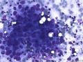 典型图片之（15）：FNA（乳腺癌）2图4