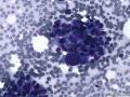 典型图片之（16）：FNA（乳腺癌）3图1