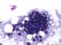典型图片之（14）：FNA(乳腺癌)1图5