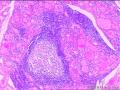 双侧甲状腺切除图19