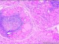 双侧甲状腺切除图4