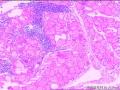 双侧甲状腺切除图7