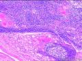 双侧甲状腺切除图12