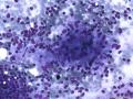 典型图片之（17）：FNA（腋窝：淋巴结核）图1