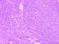 考虑恶性淋巴瘤还是坏死性淋巴结炎？图3