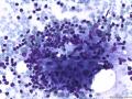 典型图片之（17）：FNA（腋窝：淋巴结核）图4