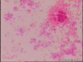 腹水癌转移？图23