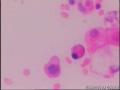 腹水癌转移？图15