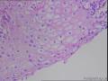 宫颈活检，遇到这种挖空细胞不典型，但HPV16阳性的，大家怎么报告？需要提示吗？图9