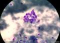 甲状腺穿刺， 有癌细胞吗？图2