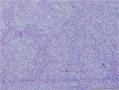 睾丸肿物：性索-间质肿瘤？不成熟畸胎瘤？或者？？？图5