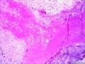 中年女性腹膜后肿块图2