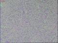 阴囊部肿物图17