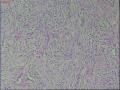 阴囊部肿物图20