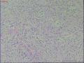 阴囊部肿物图15