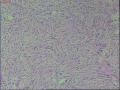 阴囊部肿物图22