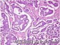 Cribriform-morular variant of papillary thyroid carcinoma图1