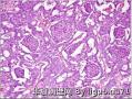 Cribriform-morular variant of papillary thyroid carcinoma图3