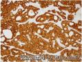 Cribriform-morular variant of papillary thyroid carcinoma图5