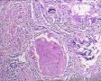 又一个皮肤肿瘤请教——增生性外毛根鞘囊肿？外毛根鞘瘤？图17